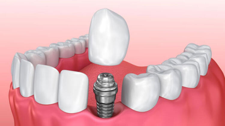 aynı gün dental implant