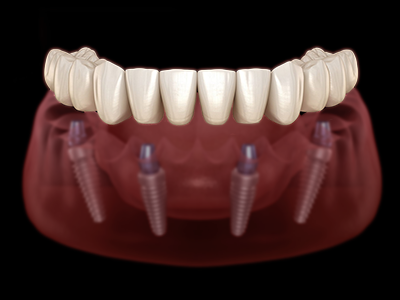 all on 4 dental implant in turkey