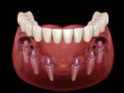 All on 6 dental implants in Turkey