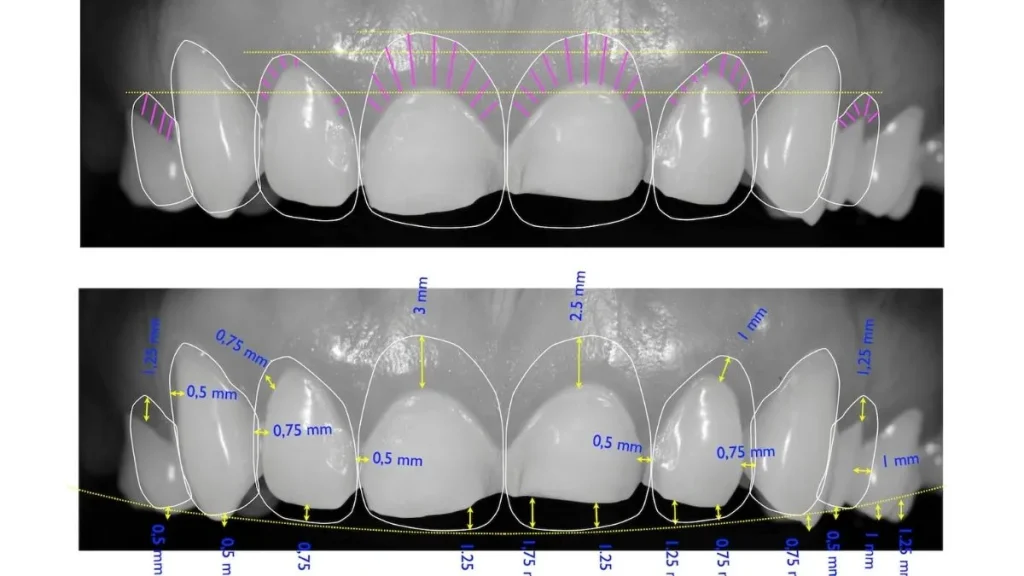 digital smile design in İstanbul