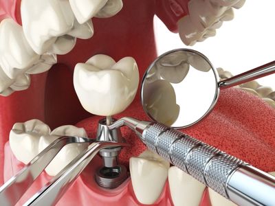 Full mouth dental implant