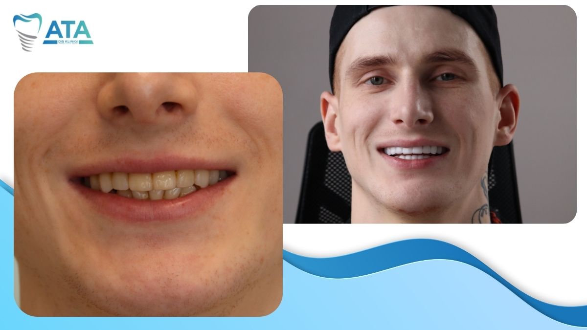 full mouth dental implants Turkey price