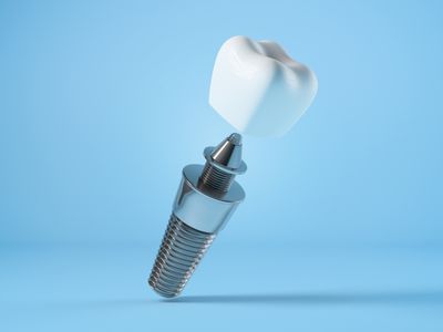 same day dental implant