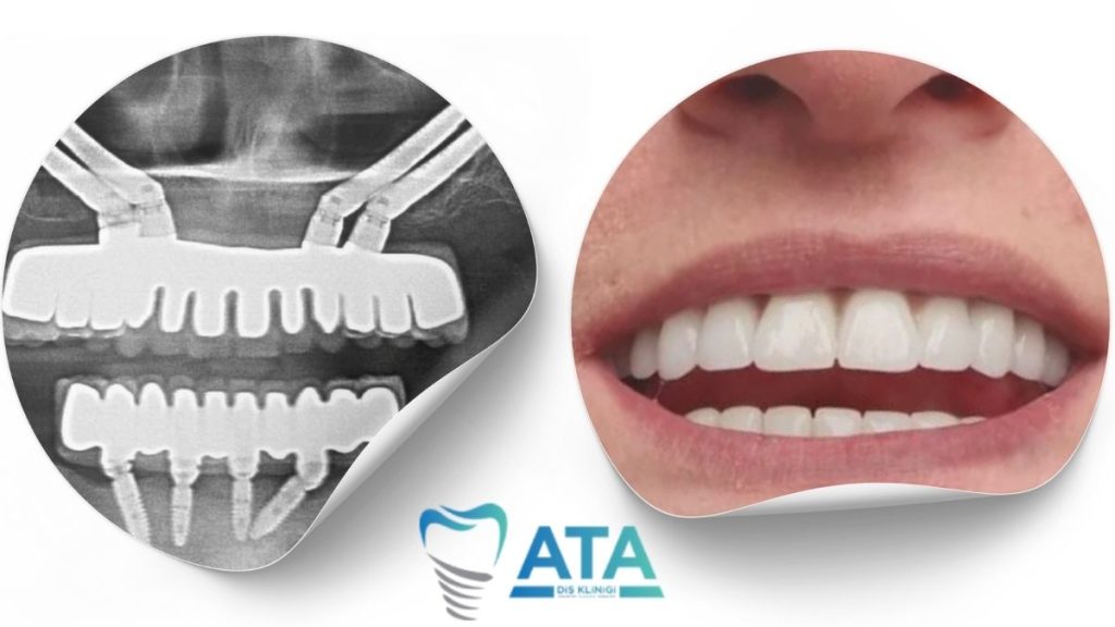 Zygomatic implant treatment in Turkey