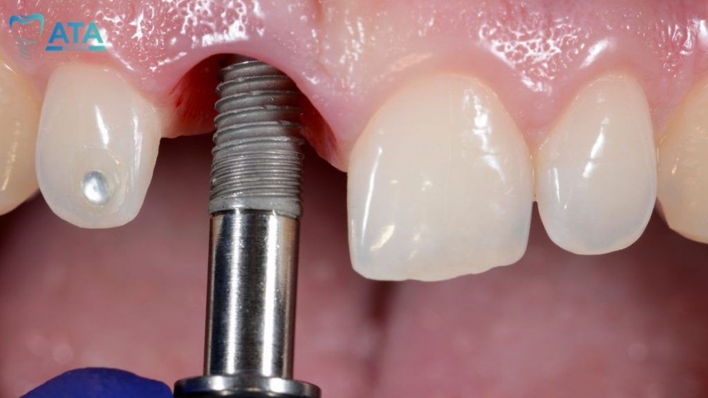 zygomatic implant turkey cost