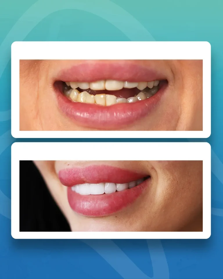 full ağız dental implant