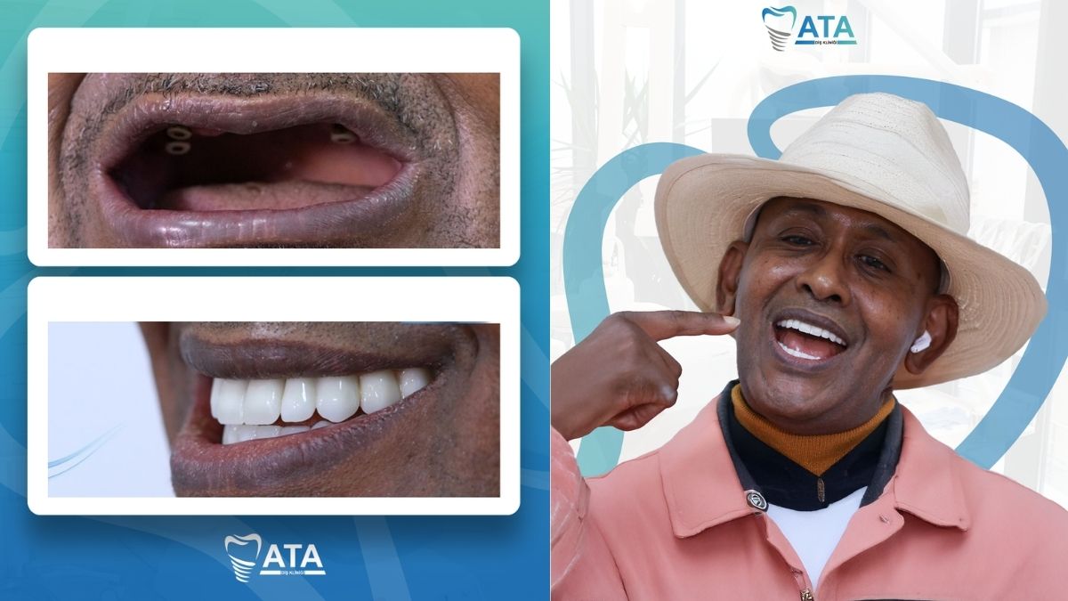 what does a dental implant look like