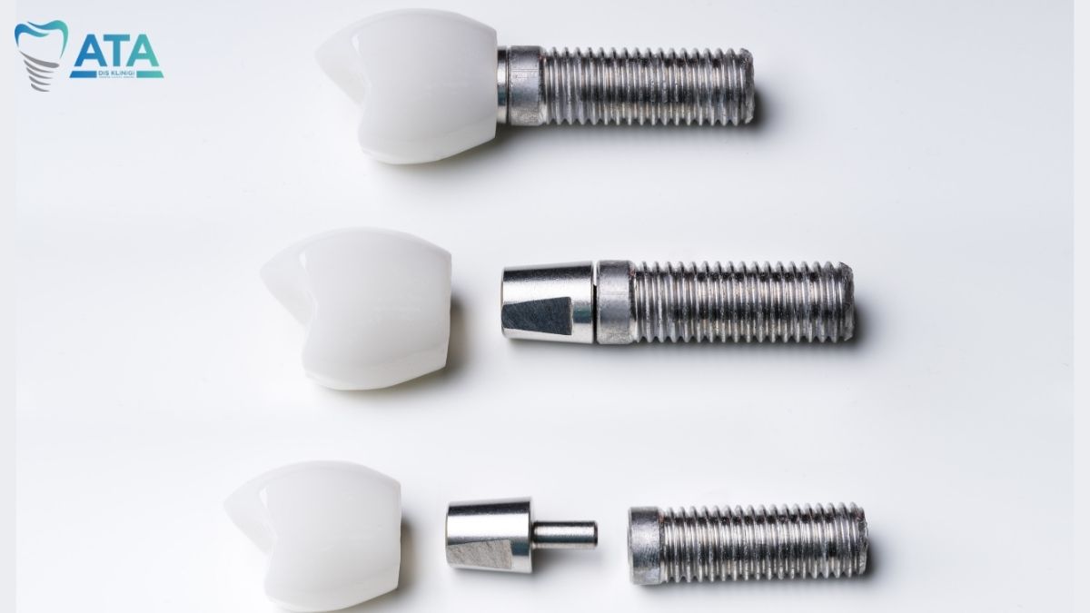 How Long Do Dental Implants Last? The Complete Guide to a Lifetime Smile