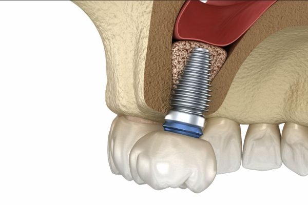 sinüs lifting nedir