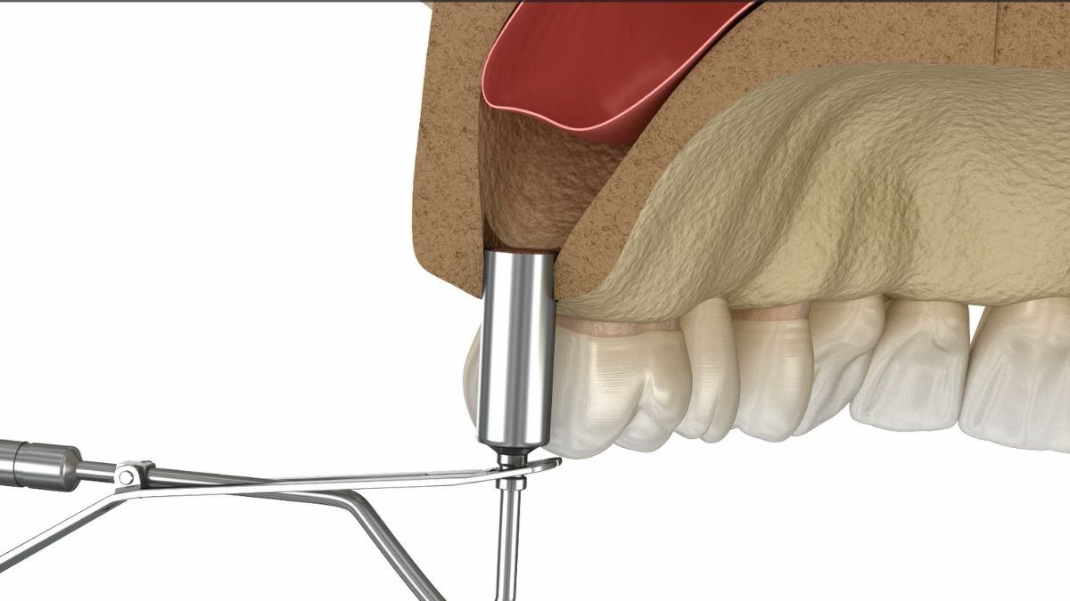 closed sinus lift