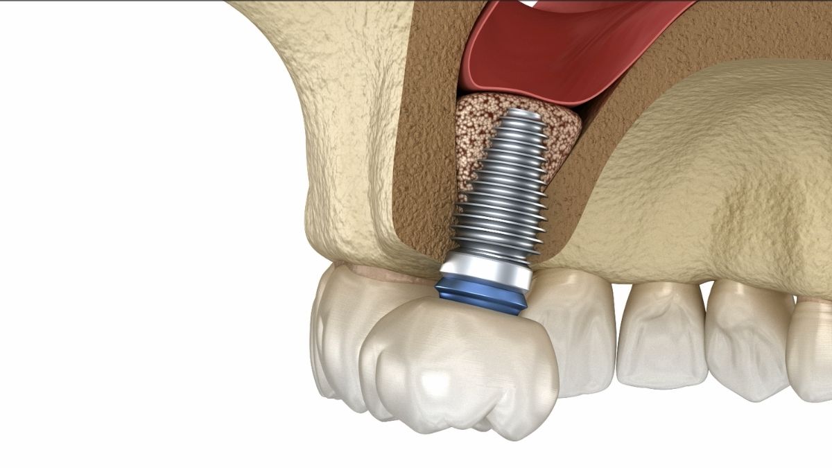 dental implants and sinus lift