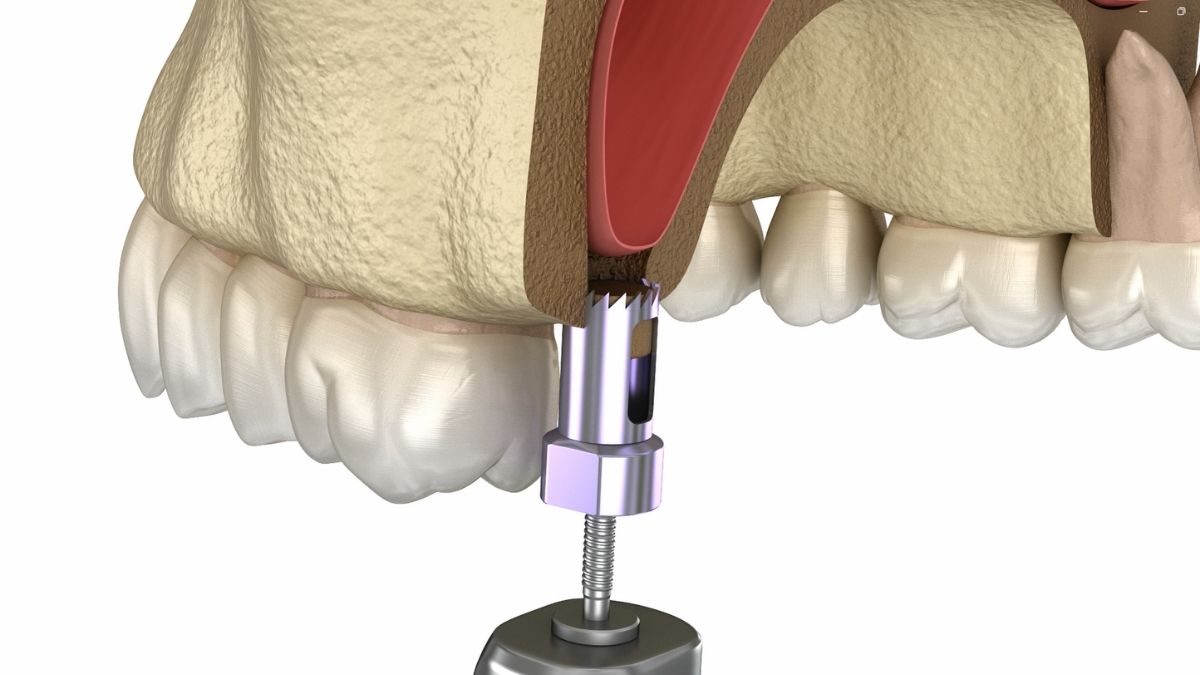 sinus lift in turkey
