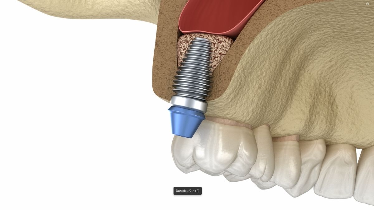 sinus lift surgery in Turkey