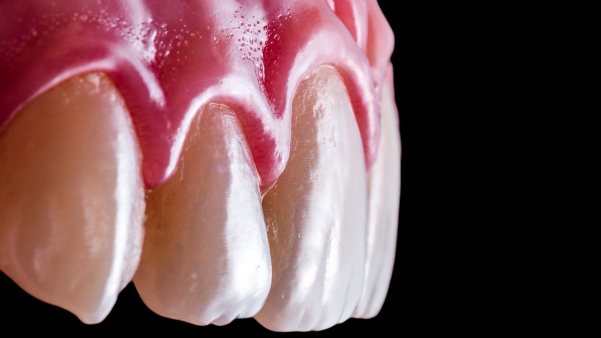 Diş Eti Çekilmesine Hangi Bölüm Bakar?