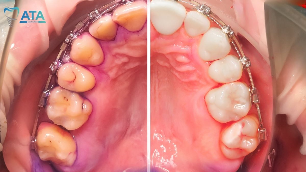 diş taşı temizliği fiyat
