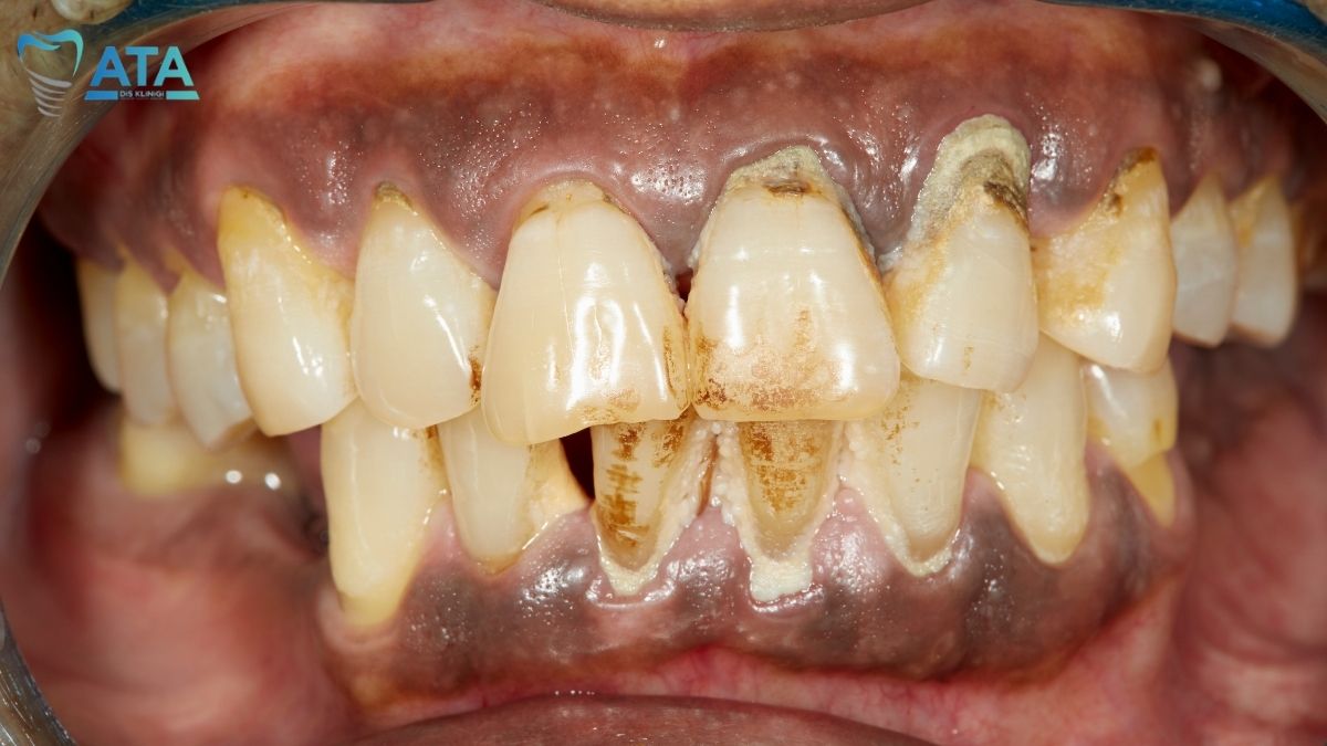 periodontitis nedir
