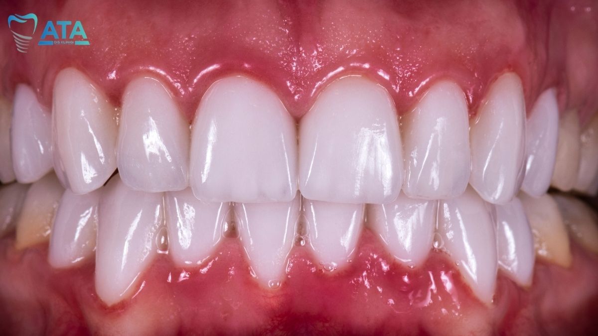 receding gums – gum (gingival) recession in Turkey