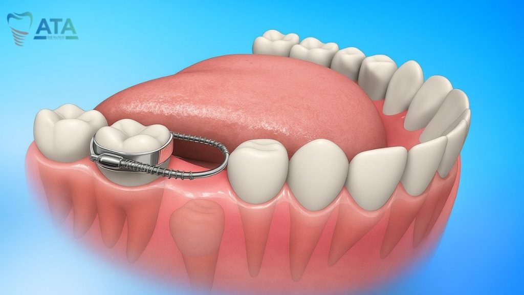 süt dişi sabit yer tutucu