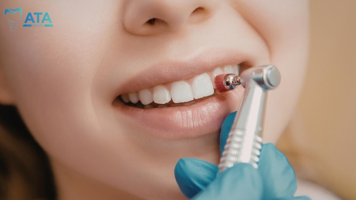 dental bonding cost turkey