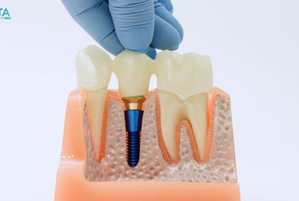 implant vidası takıldıktan sonra diş ne zaman takılır