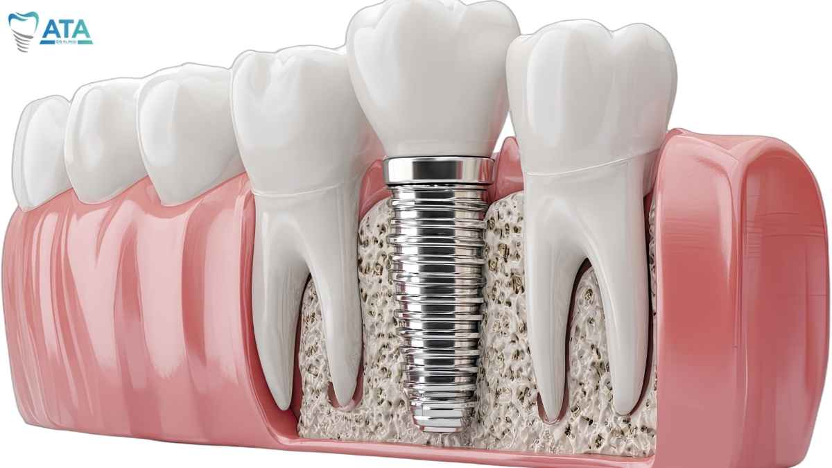 benefits of dental implants over bridges