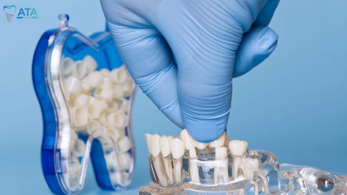 5 Best Alternatives to Dental Implants (Cost, Durability & Comparison Guide)