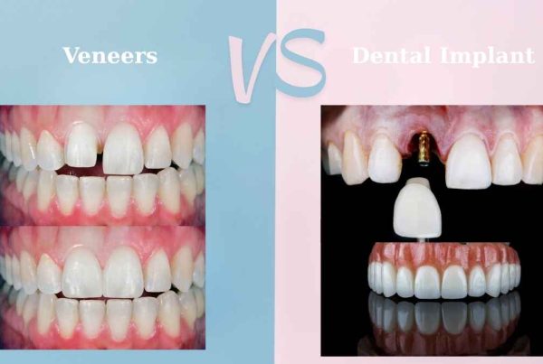 dental implants vs veneers