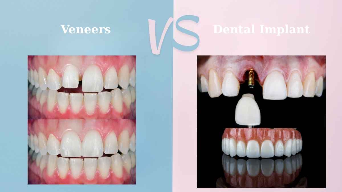 Dental Implants vs Veneers: Which One Is Right for You?