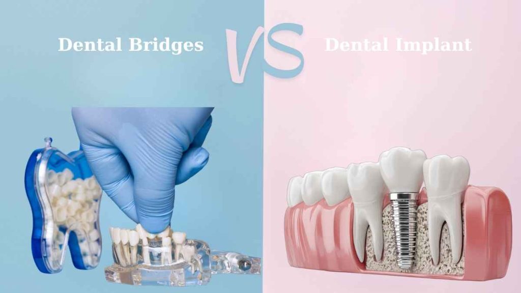 Dental Bridge vs. Implant: Which is the Best Investment for Your Smile ...