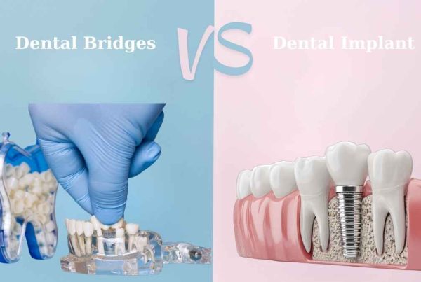 dentistry bridges vs implants