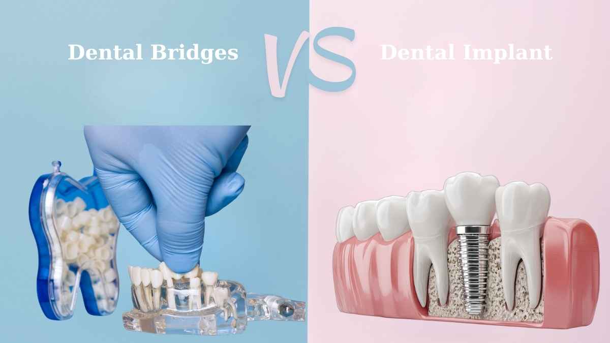 Dental Bridge vs. Implant: Which is the Best Investment for Your Smile in 2026?