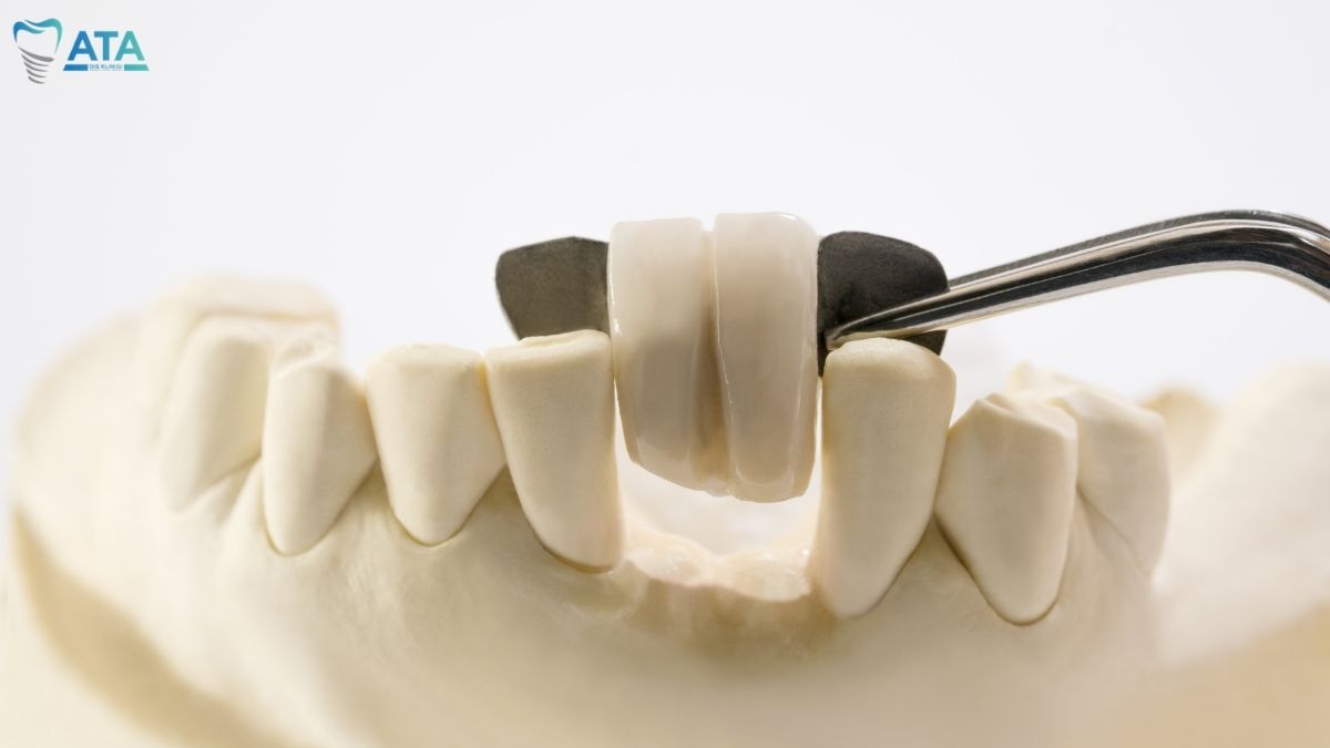 best alternatives to dental implants