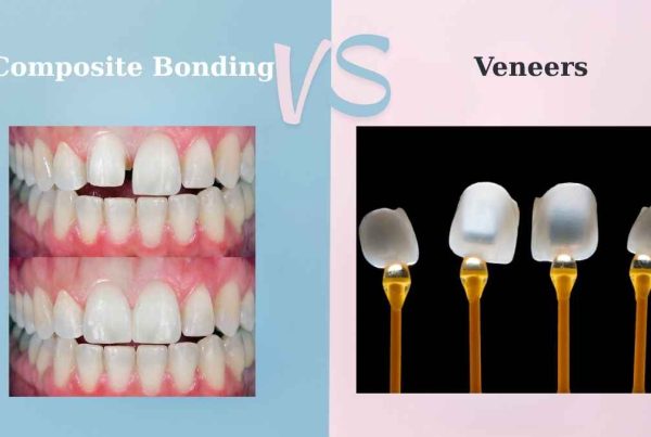 teeth bonding vs veneers
