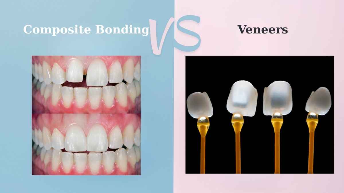 Composite Bonding vs Veneers: Which One Is Right for You?